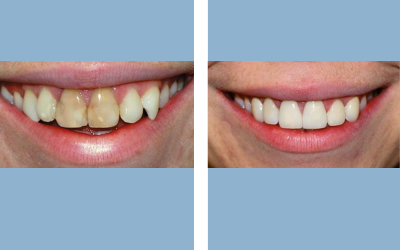 Before and After